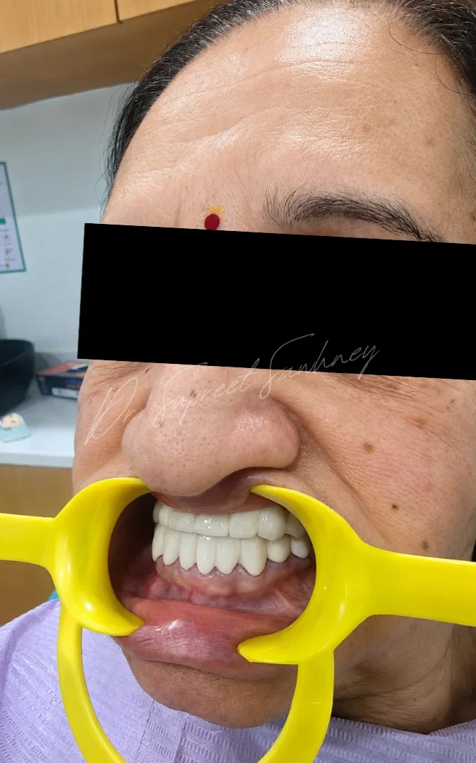 Patient smiling with completed full-mouth fixed restorations, with eyes obscured for privacy